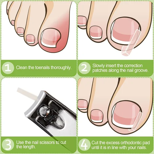 Miniatura 4 de 100 tiras correctoras de uñas encarnadas, parches de corrección de uñas de los pies, parches curvos para enderezar las uñas de los pies, clips