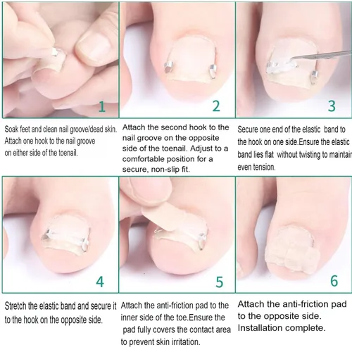 Miniatura 4 de Kit corrector de uñas encarnadas para hombres y mujeres, herramienta de uñas encarnadas, 2 clips de acero inoxidable, tiras de uñas curvas