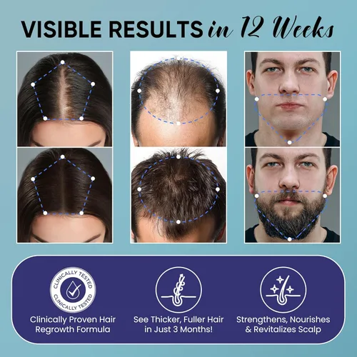 Miniatura 3 de Kit de crecimiento del cabello de minoxidil al 5% para hombres y mujeres: Minoxidil Spray Tratamiento de recrecimiento del cabello con biotina