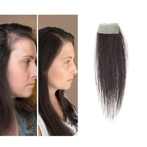 Miniatura 44 de Reemplazo de cabello humano con cicatrices, quemaduras accidentales sin vello para hombres y mujeres, pérdida de línea de cabello, cinta recta