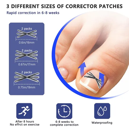 Miniatura 3 de Corrector de uñas encarnadas de aleación de titanio con diseño mejorado en forma de MI para alivio rápido del dolor, kit de herramientas