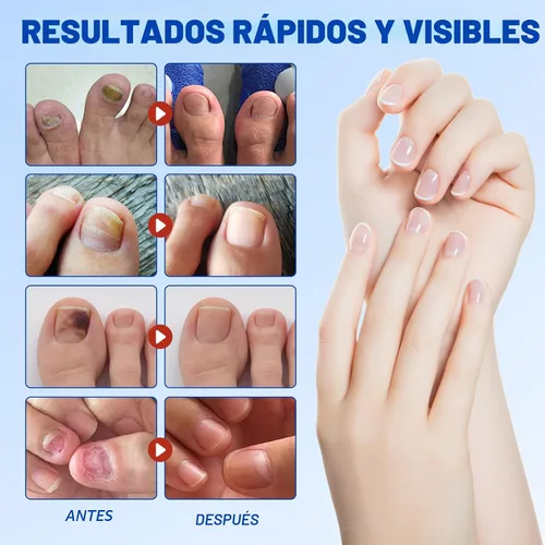 Miniatura 6 de Parches de uñas: 21 parches de reparación extra fuertes para uñas de los pies y uñas dañadas, cuidado de uñas durante la noche de 8 horas
