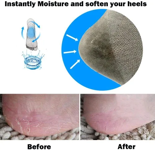 Miniatura 5 de Codream calcetines talón gel humectante ventilado, para el día o la noche, juegos para el cuidado del píe, dedo abierto, nuevo tratamiento