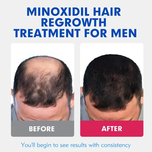 Miniatura 2 de Fytikal 5% de minoxidil para hombres tratamiento de crecimiento del cabello, solución tópica extra fuerte para adelgazamiento del cabello