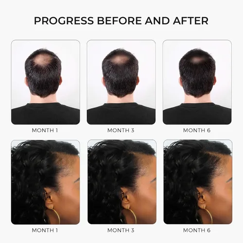 Miniatura 4 de Champú de minoxidil fortalecedor del cabello, aceite de ricino, biotina, aceite de aguacate, cafeína, palma enana americana, cebolla y redensyl