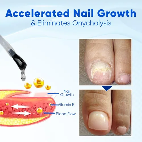 Miniatura 4 de OnyxoGuard - Suero de crecimiento y reparación de uñas, suero avanzado para el crecimiento de uñas, fortalecedor y crecimiento de uñas, revitaliza