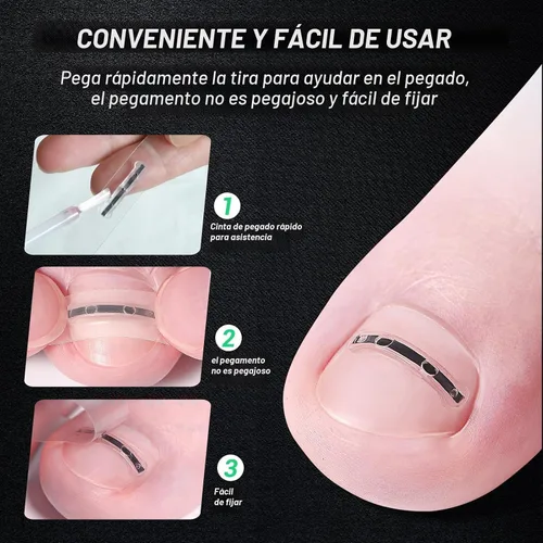 Miniatura 3 de Tratamiento de uñas encarnadas de aleación de titanio, herramientas de uñas y kit de eliminación de uñas encarnadas especialmente diseñado